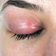 Picture of Blepharitis