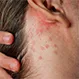 How Do You Stop Guttate Psoriasis From Spreading?
