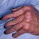 Psoriatic Arthritis Symptoms, Treatment, Diagnosis