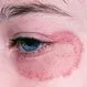 Picture of Ringworm Tinea Corporis (Faciei)